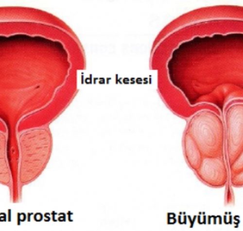 iyi-huylu-prostat-buyumesi-(bph)-tedavisinde-holep-ameliyati